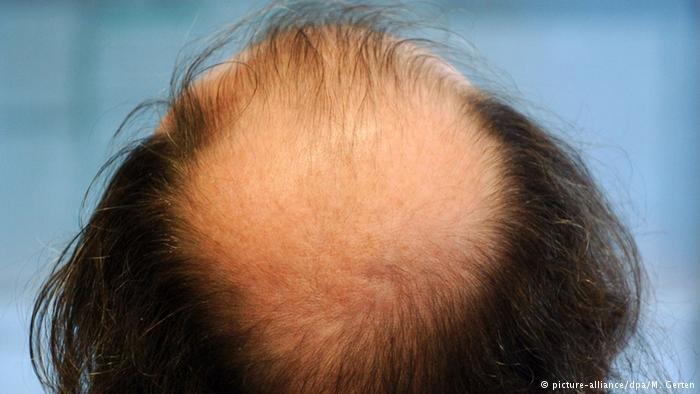 دراسة: زراعة الشعر قد تزيد جاذبيتك لدى الآخرين