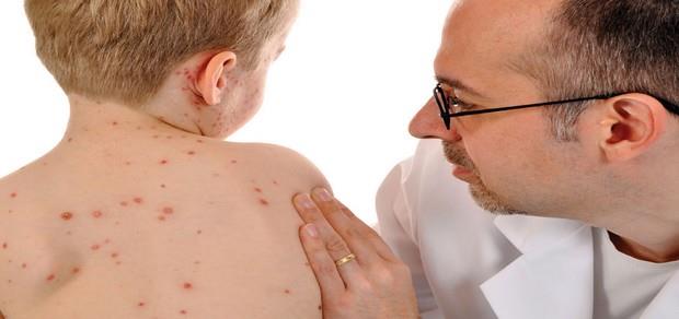 تعرف على مرض "الجلد الفقاعي".. يصيب الأطفال.. وطبي