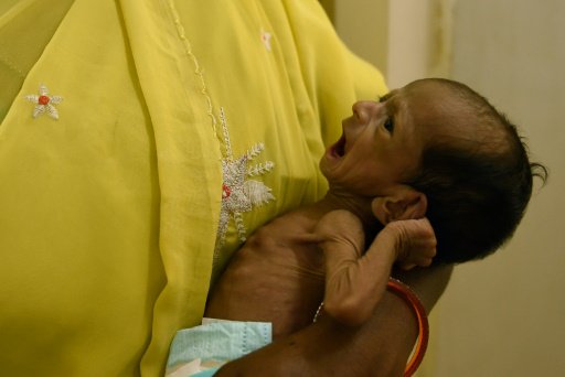 رضيع هندي يعاني من سوء التغذية تحمله ممرضة في مستش