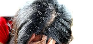 4 مواد طبيعية لعلاج قشرة الشعر بسهولة..غير الخل
