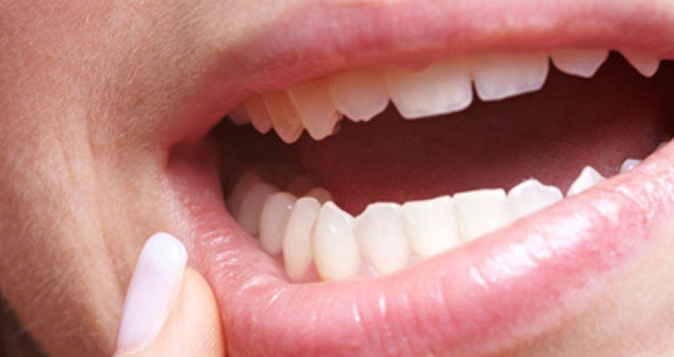 نصائح طبية لتخفيف آلام فطريات الفم