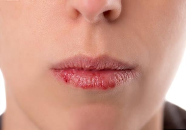  13 سبب لجفاف الفم واللسان.. منها "التوتر والاكتئا
