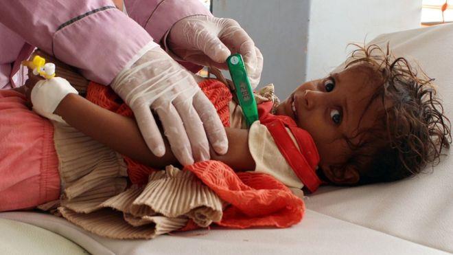 أغلب المصابين بالكوليرا في اليمن أطفال يعانون أصلا