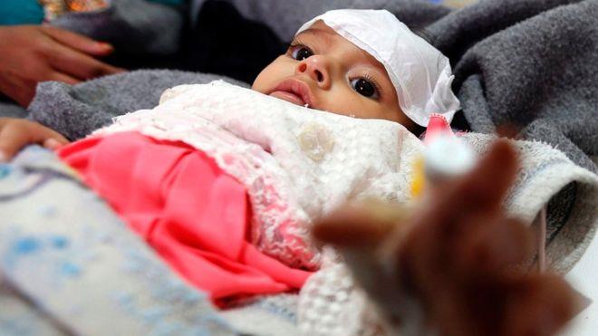 أكثر من مليون طفل يمني معرضون للموت بسبب الكوليرا