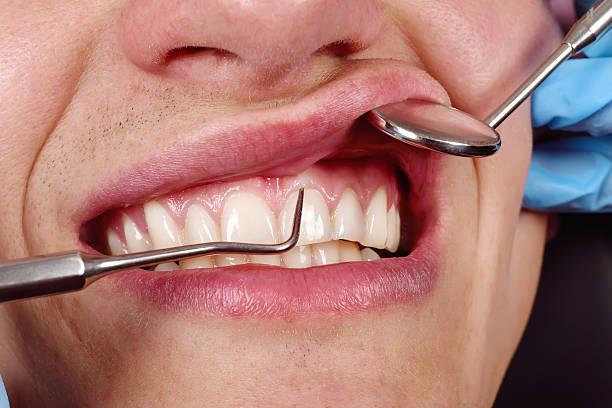 الآثار الجانبية للأدوية على صحة الفم والأسنان والل