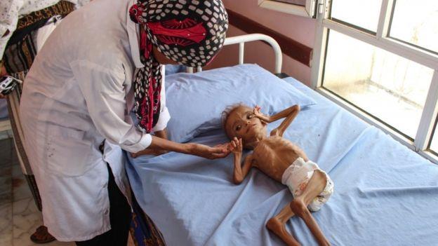 ضحايا حرب اليمن
