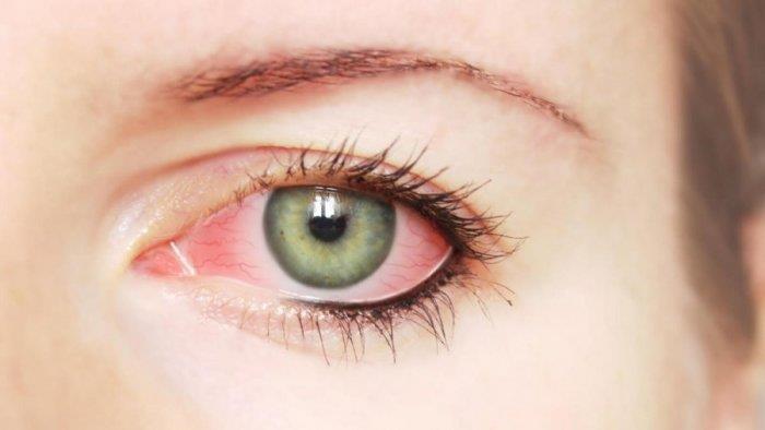 5 نصائح مهمة لمرضى حساسية العيون من تقلبات الجو هذ