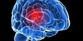 علاج مضمون وسريع للشفاء من استسقاء المخ.. (فيديو)