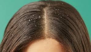 طرق طبيعية للتخلص من قشرة الشعر في بداية الشتاء