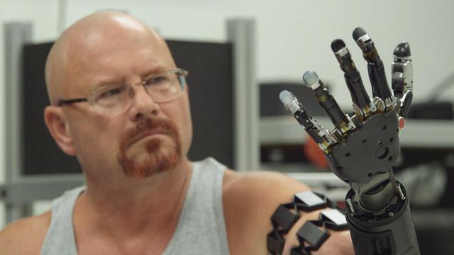 أول إنسان يتعايش مع ذراع روبوتية يتحكم بها بعقله