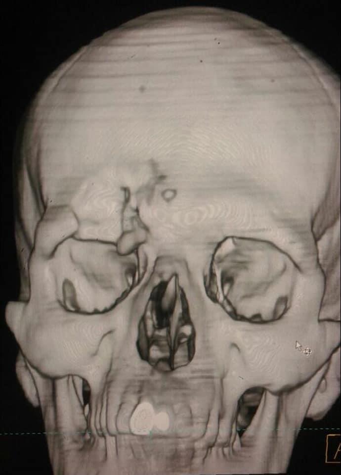 اشعة للمصاب بكسر في الجمجمة قبل الجراحة