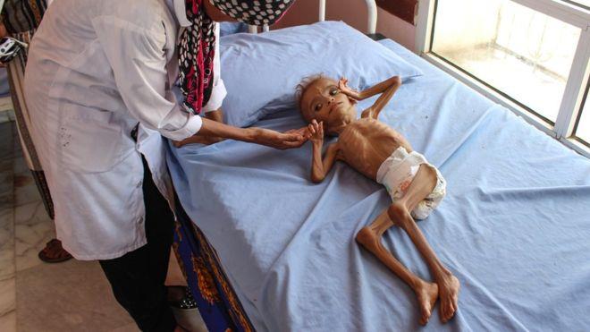 أزمة نقص الغذاء في اليمن