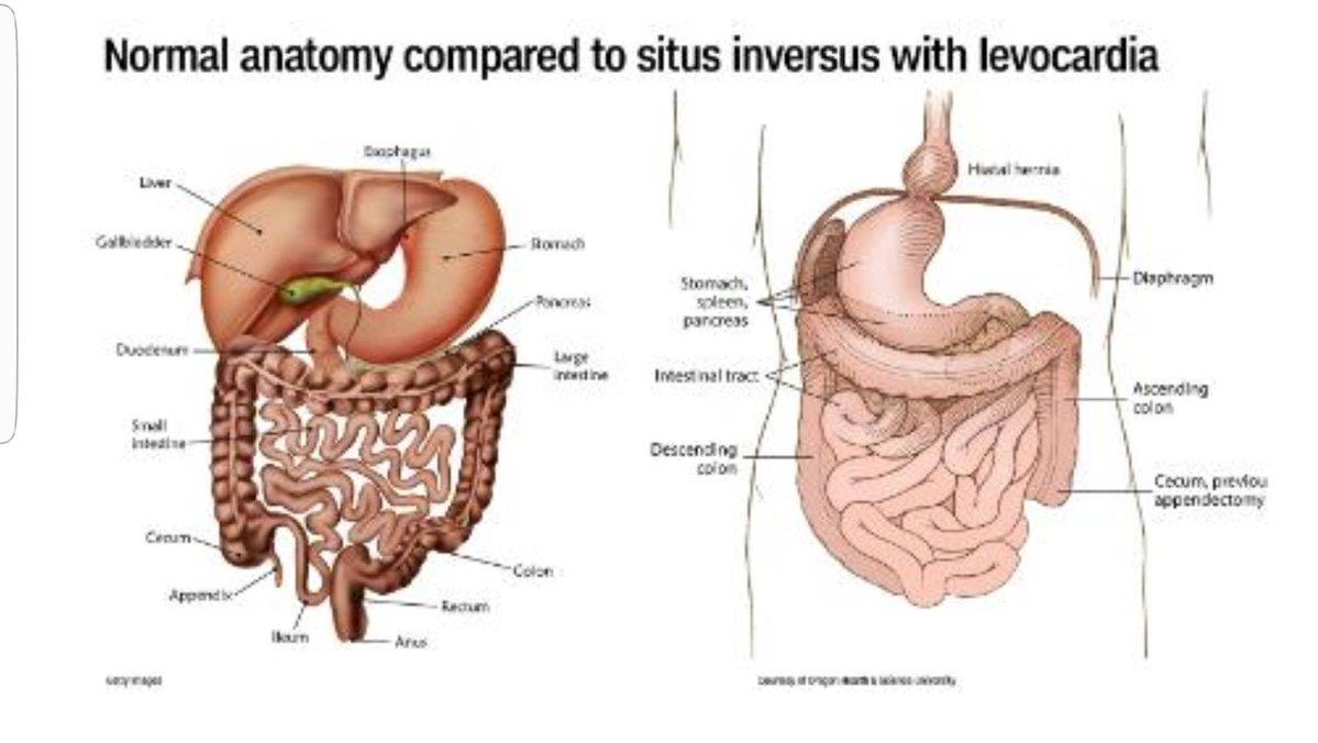 صورة توضح الفارق بين الحالة الطبيعية للأعضاء وحالة روز