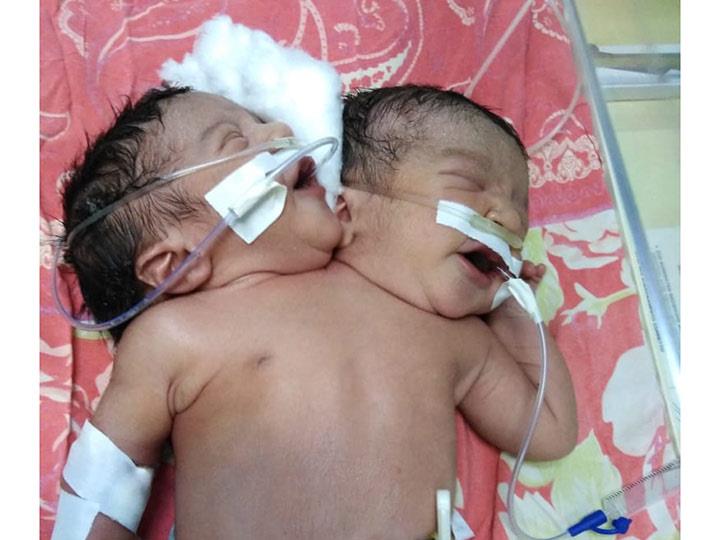 حالة-وضع-طفل-برأسين