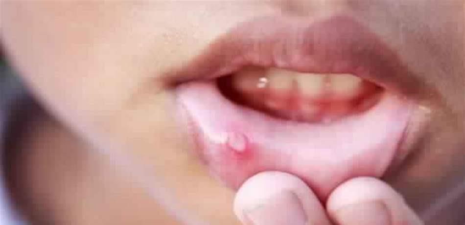 أعراض تحدث في الفم تدل على حالة صحية خطيرة