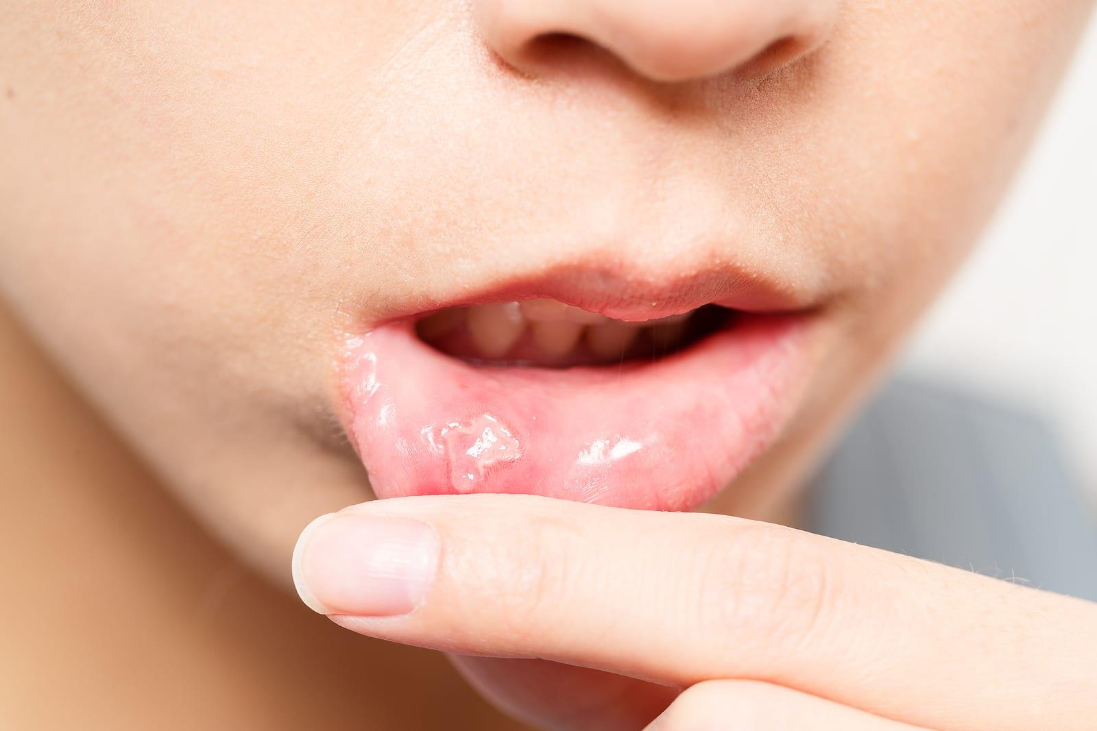 قرحة الفم.. تعرف على أسبابها وطرق العلاج