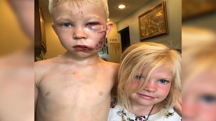 بريدجر ووكر الطفل الذي تصدى للكلب الشرس دفاعًا عن شقيقته