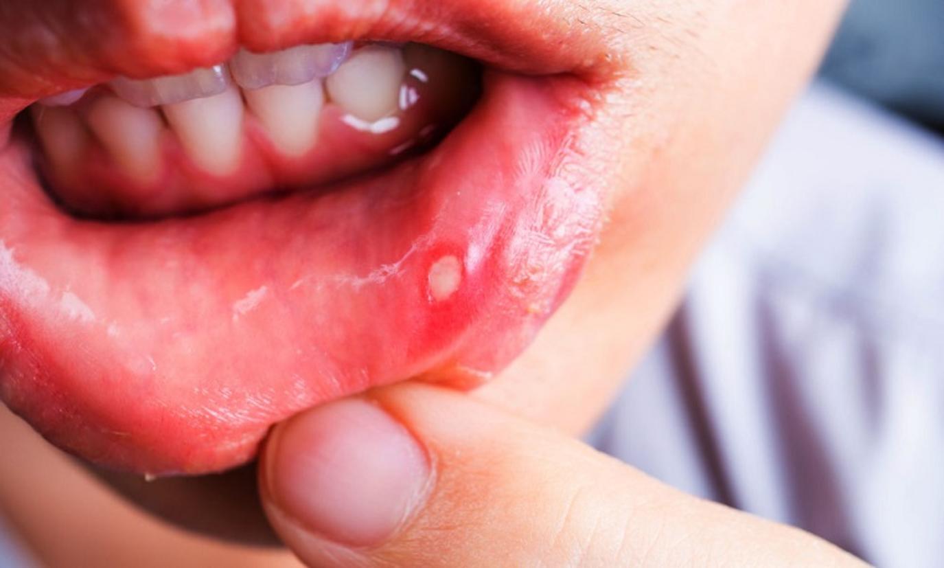 لماذا تهاجم الفطريات الفم؟