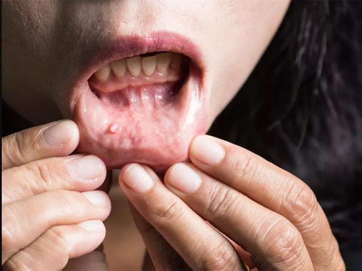 أعراض تنذر بسرطان الفم والحلق