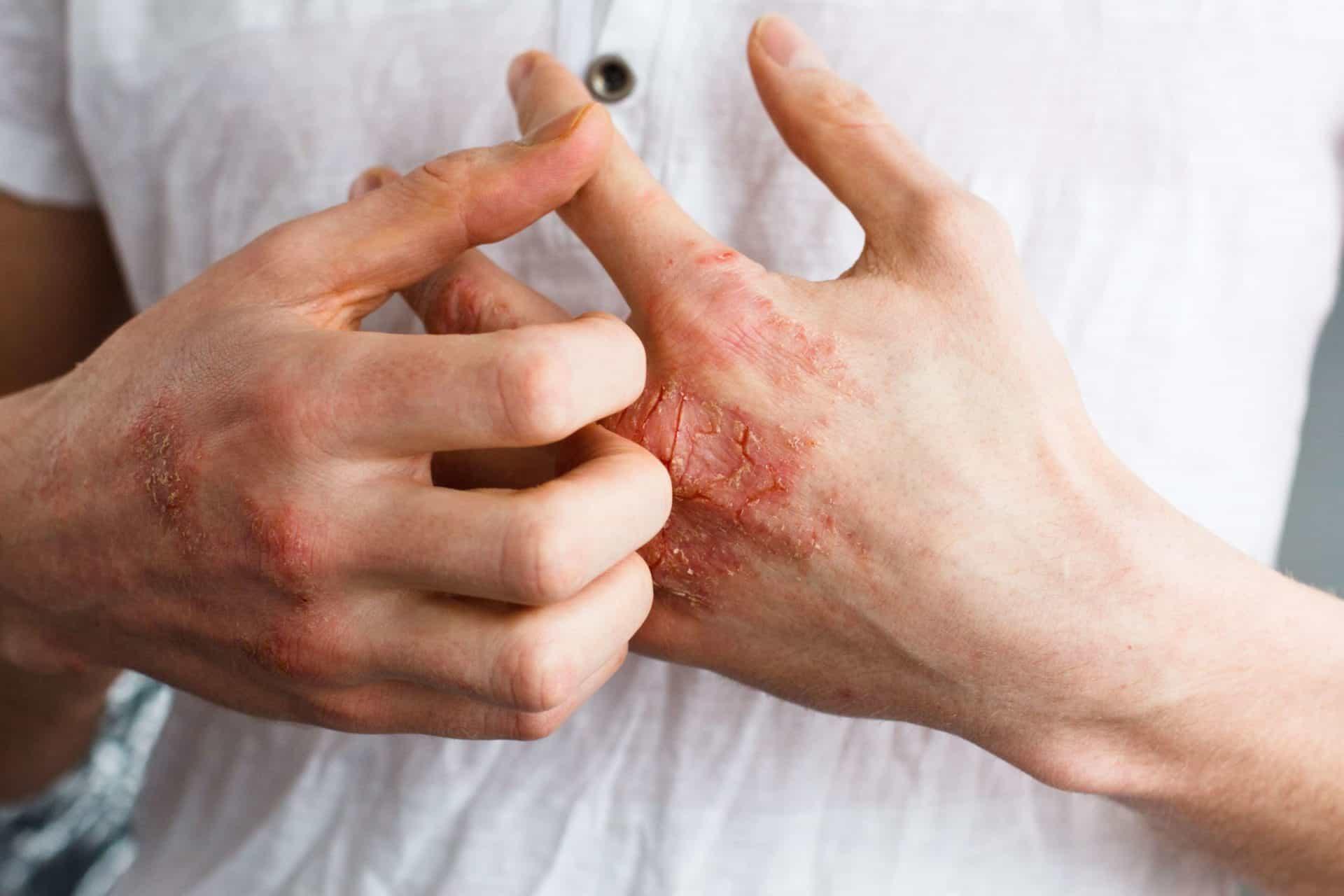 علامة على الجلد تشير إلى الإصابة بارتفاع الكوليستر