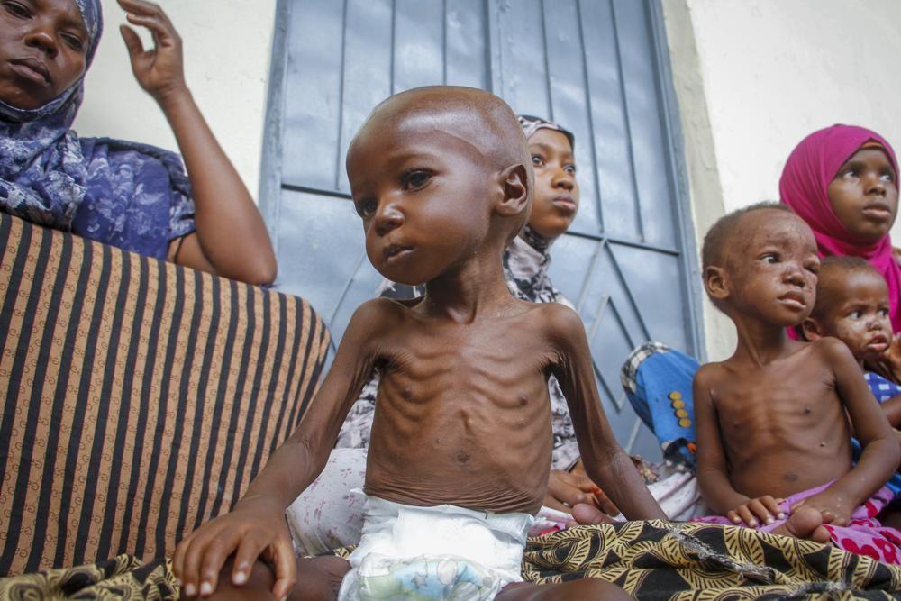 سوء التغذية في السودان