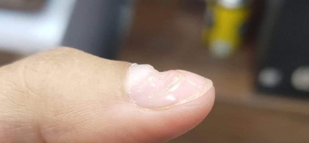 سيدة تنشر صورا لأظافرها المتآكلة.. والسبب غير متوقع