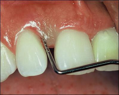 التهاب دواعم الأسنان