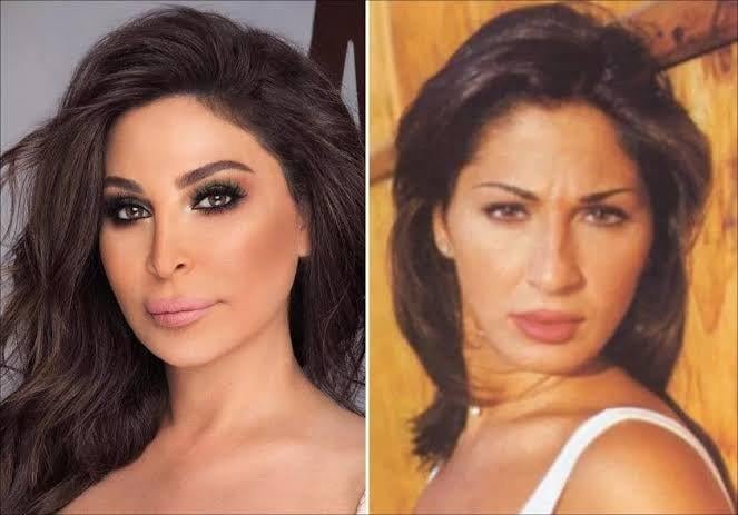 تشوه بالوجه وفقدان حاسة الشم.. فنانات تشوهن بسبب عمليات التجميل | مصراوي