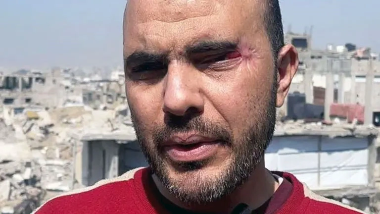 أكد طبيب عيون متخصص في غزة أن أبو طويلة أصيب بحروق كيميائية في العين، أدت إلى إتلاف الجلد المحيط بها