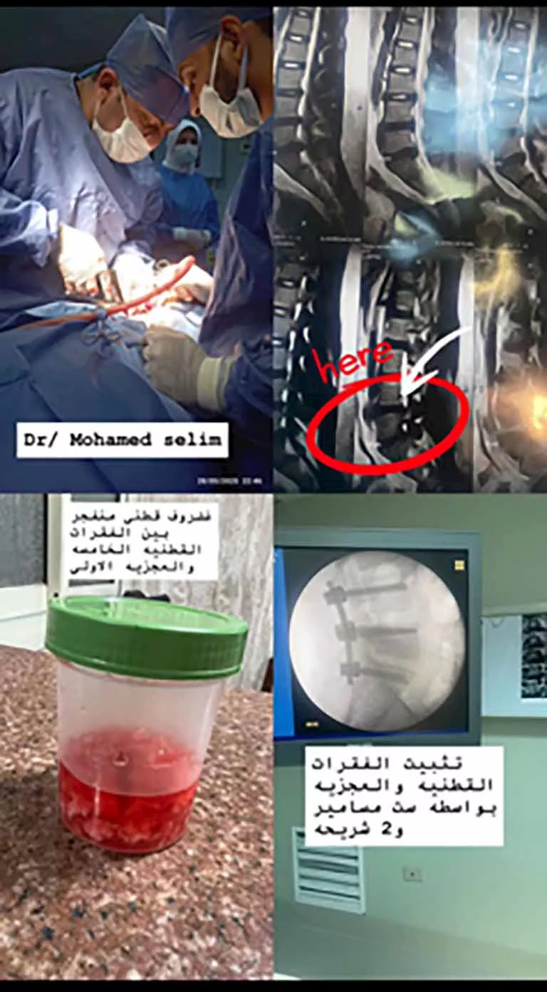 جراحة دقيقة بمستشفى تمى الأمديد تعيد شابًا للحركة