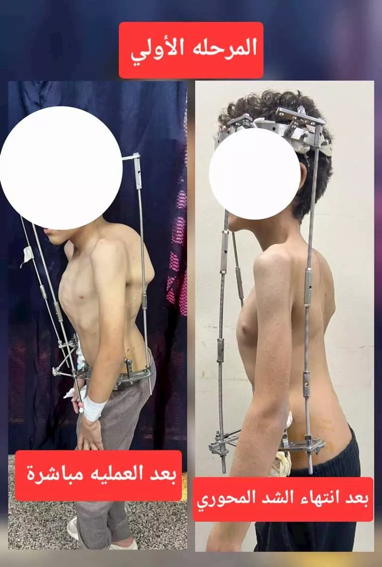 فريق طبي بالزهراء الجامعي يجري جراحة نادرة لطفل