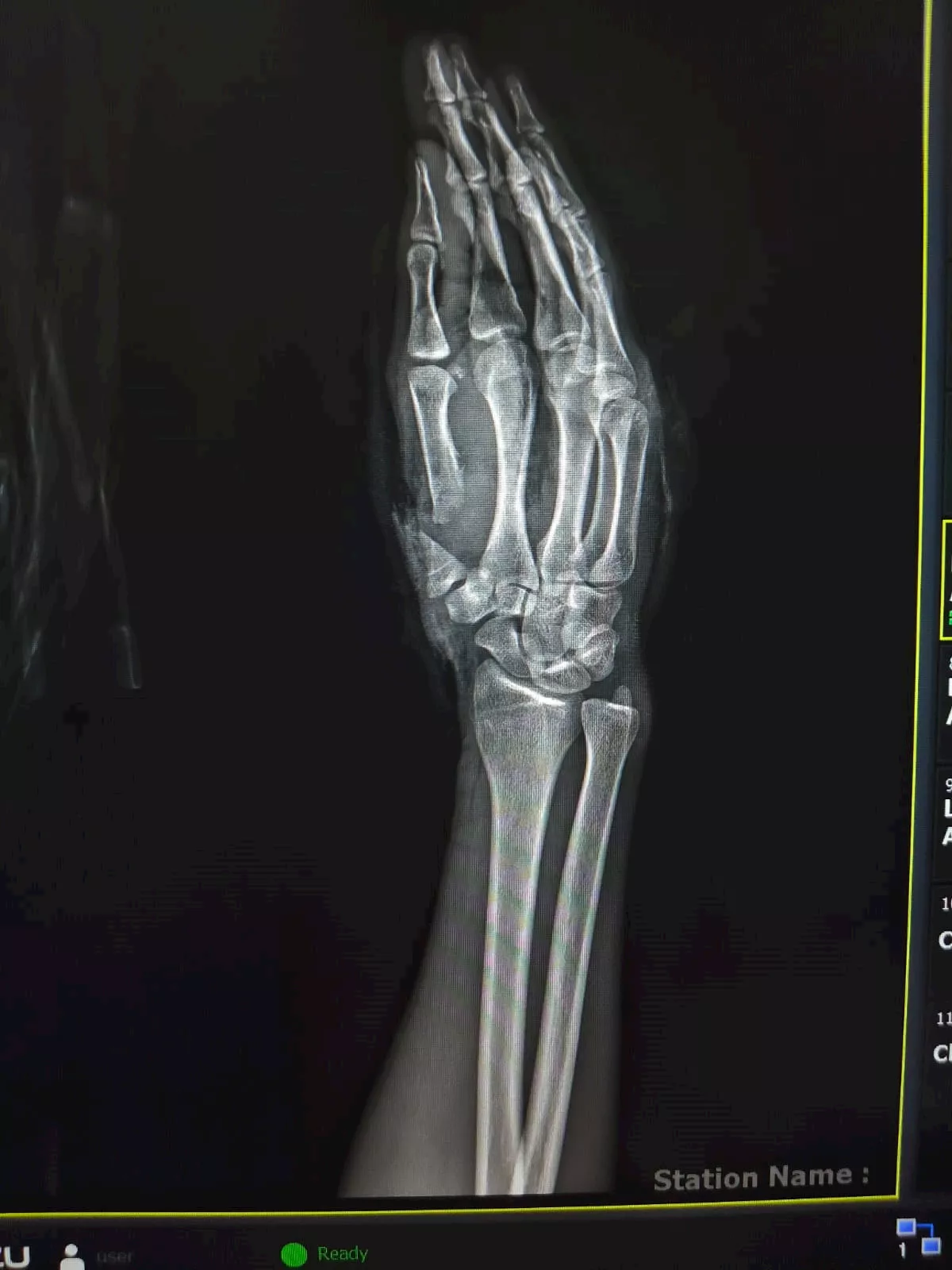 الأشعة على اليد