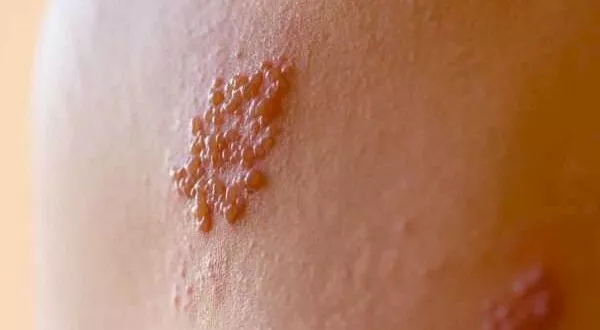 مرض الحزام الناري أسبابه وأعراضه وطرق الوقاية منه (2)