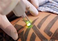 إزالة الوشم