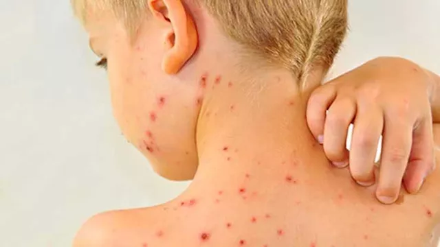 مرض الجدري - ارشيفية                              