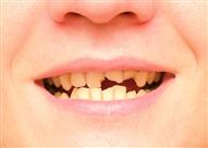   ماذا تفعل بالأسنان المخلوعة أو المكسورة؟