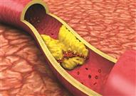 الدهون الزائدة