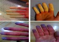 ظاهرة رينود