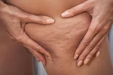 أسباب ظهور السيلوليت مع التقدم في العمر.. تعرف عليها    