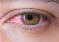 متى يشير حرقان العين إلى مشكلة صحية خطيرة؟