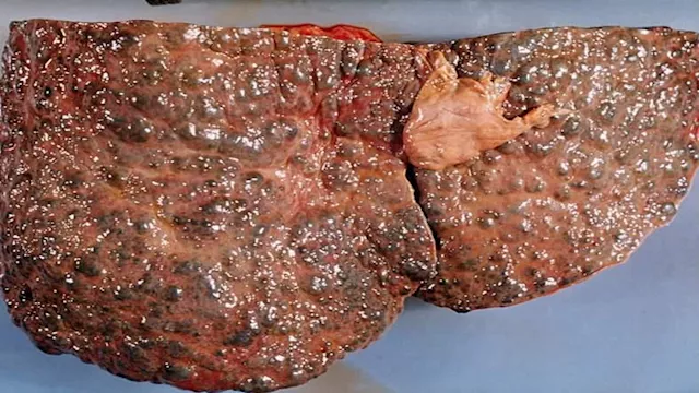  تلف الكبد الدائم