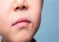 عدوى الهربس