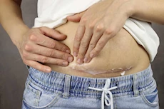 بعد الولادة القيصرية..5 نصائح ضرورية للتعافي