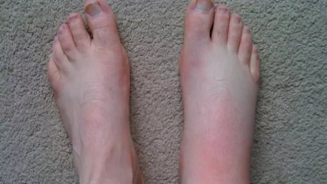 تورم  الساقين