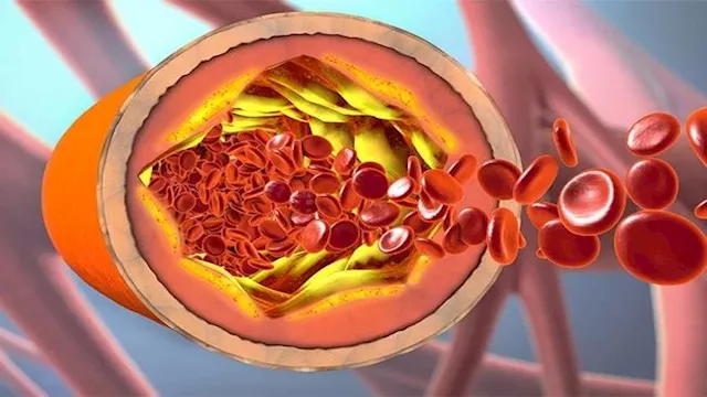 الكوليسترول الخفي.. علامات في القدمين تكشف الخطر 