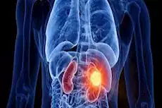 في هذه الحالة التهابات المسالك البولية علامة على س