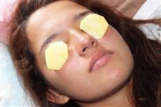 البطاطا علاج فعال للهالات السوداء- حقيقة أم خرافة؟