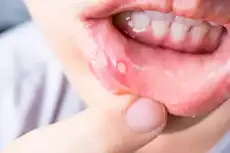فطريات الفم عند الأطفال.. إليك الأسباب