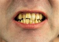 احذر- تغير أسنانك لهذا اللون علامة على إصابتها بالتكلس