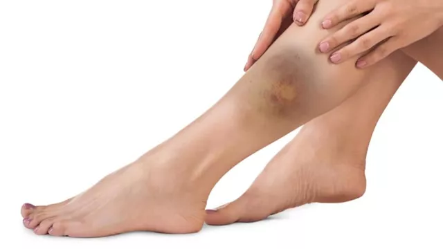 احذر.. الكدمات الغامضة في جسمك علامة على مشكلة صحي